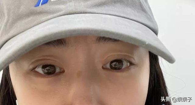 没事千万不要割双眼皮看景甜真实素颜这眼皮褶皱怎么会这样